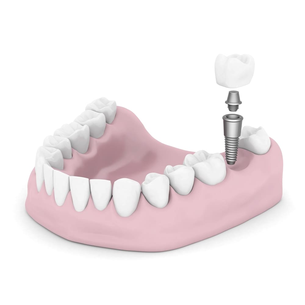 Denver Dental Implants near me