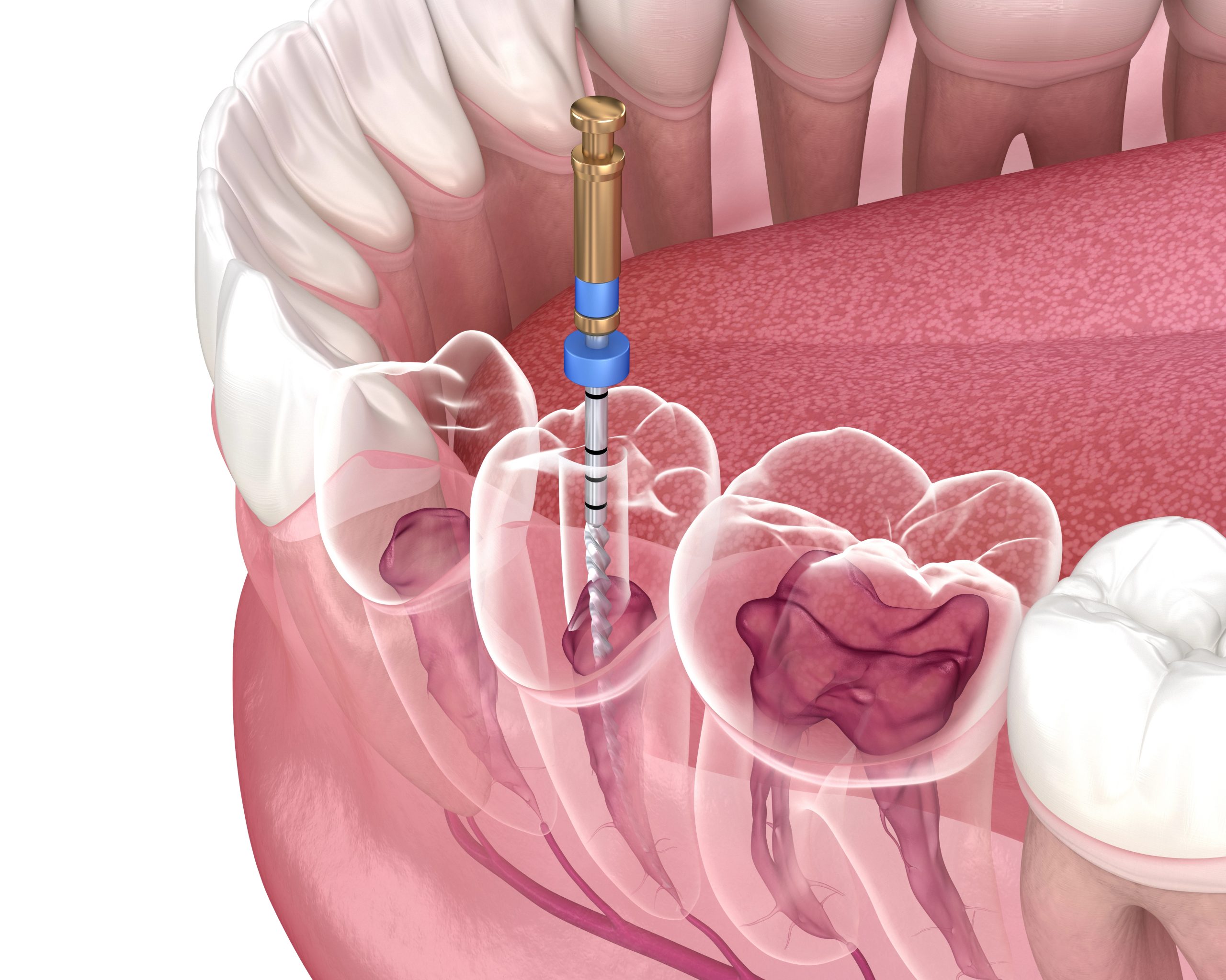 Unveiling the Truth Behind Root Canal Therapy: Top 5 Common Misconceptions You Need to Know