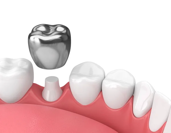 Recognizing When Denver Patients Need Dental Crowns Due to Decay, Damage, and Wear