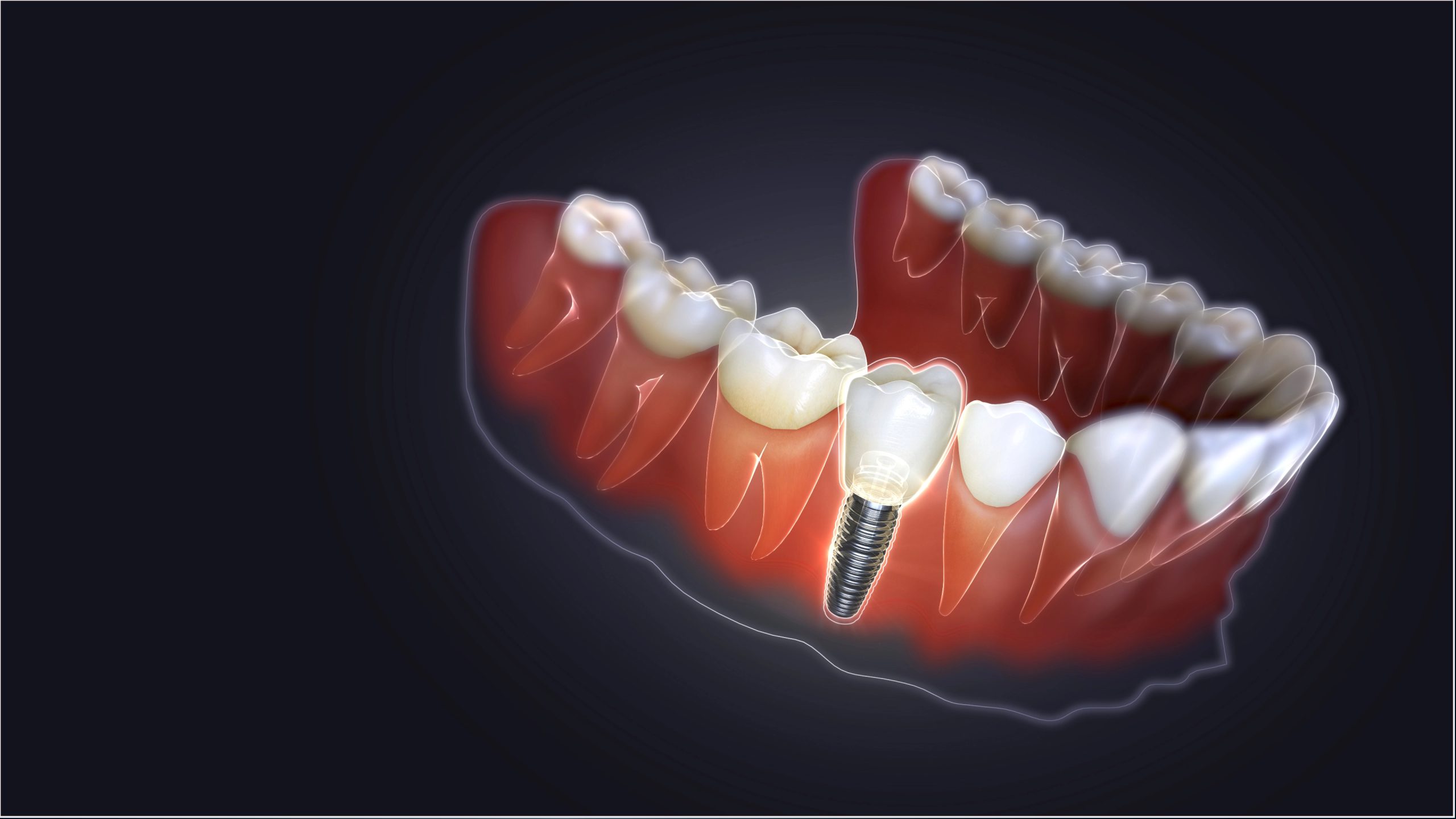 Are Dental Implants the Right Choice for Your Missing Teeth?